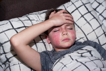a boy of European appearance with red spots on his face is lying in bed with his hand on his forehead - obrazy, fototapety, plakaty