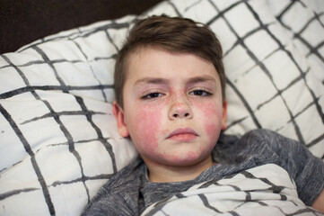 a boy of European appearance with the first signs of the virus, red spots on his face. Allergy on...