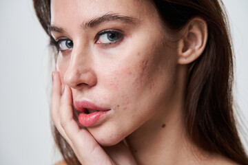 Woman with with post acne spots at her face looking at the camera - 474636544