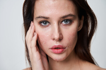 Beautiful young woman with problematic skin looking at camera with serious expression