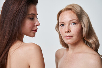 Woman with problematic skin looking at her freckled girlfriend while posing