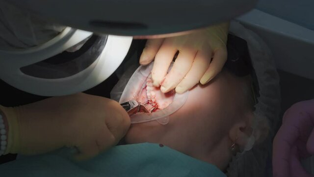 real. dentist pulls out a sick wisdom tooth. 