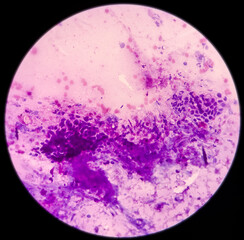 High grade squamous intraepithelial lesion(HSIL). Photomicrograph of conventional pap smear. Reactive cellular changes associated with severe inflammation. Focus view.