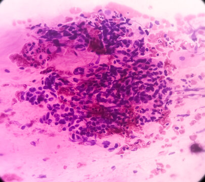High grade squamous intraepithelial lesion(HSIL). Photomicrograph of conventional pap smear. Reactive cellular changes associated with severe inflammation. Focus view.