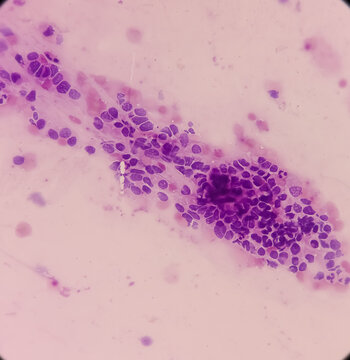 High grade squamous intraepithelial lesion(HSIL). Photomicrograph of conventional pap smear. Reactive cellular changes associated with severe inflammation. Focus view.