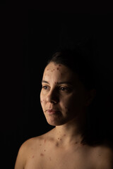 Fototapeta na wymiar adult woman portrait chickenpox disease