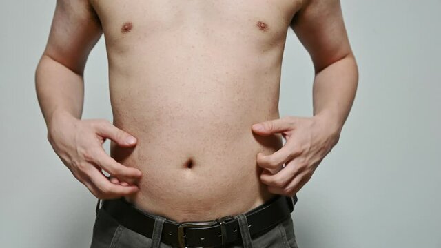 Dermatitis viral disease of young adult asian body standing scratching abdomen with itching, Red Rash, Measles Virus, Viral Exanthem