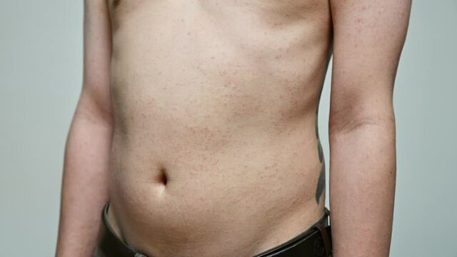 Dermatitis viral disease of young adult asian body standing scratching abdomen with itching, Red Rash, Measles Virus, Viral Exanthem