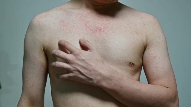 Dermatitis viral disease of young adult asian body standing scratching with itching, Red Rash, Measles Virus, Viral Exanthem