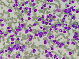 Photomicrograph of Acute Myeloblastic Leukemia (AML), a cancer of white blood cell. Microscopic...