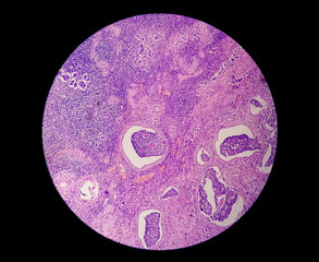 Low power photomicrograph of a breast core biopsy showing an invasive ductal carcinoma grade-II,  most common form of breast cancer. Lymphovascular invasion: Present
