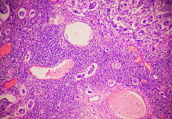 Low power photomicrograph of a breast core biopsy showing an invasive ductal carcinoma grade-II, ...
