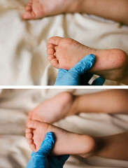 Collage rash of enterovirus infection picornavirus families on the feet of a 3-year-old child. Medicine, health concept.