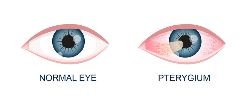 Eye healthy and with pterygium. Conjunctival degeneration before and after surgery. Eye disease. Human organ of vision with pathology. Vector realistic illustration.