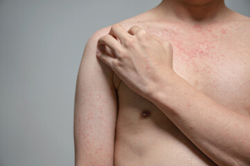 Dermatitis rash viral disease with immunodeficiency on body of young adult asian, scratching with itching