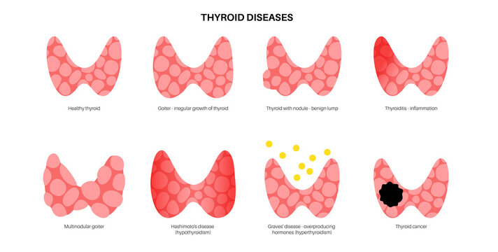 thyroid gland disease