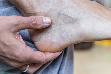 Blisters on the foot of a Caucasian man sitting on the couch at home - obrazy, fototapety, plakaty