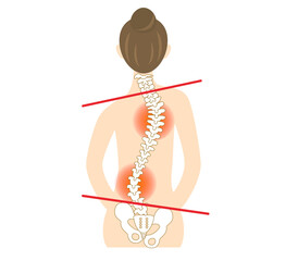 Illustration of the back of a woman with scoliosis and a bent spine.