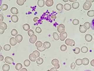 Essential thrombocytosis blood smear showing abnormal high volume of platelet and low count of...