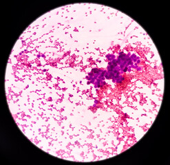 Parotid swelling, malignant cell consistent with mucoepidermoid carcinoma, squamous cells, chronic inflammatory cells and hemorrhage background, FNAC
