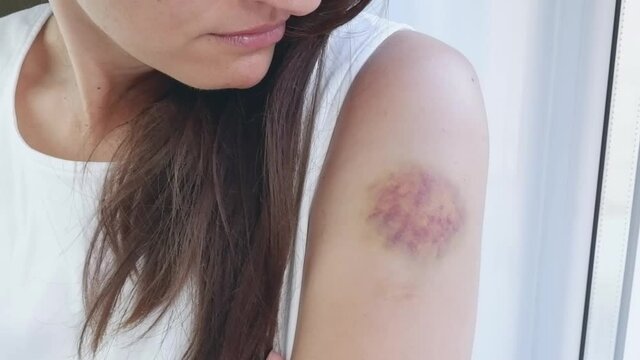 A woman in a white T-shirt by the window touches a large bruise on her arm with her hand. Domestic violence concept