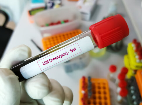 Blood sample tube for LDH (isoenzyme) test. lactate dehydrogenase, diagnosis for cellular destruction or tissue damage