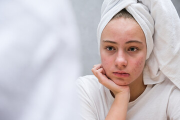 Acne. A sad teenage girl. Problematic skin in adolescents.