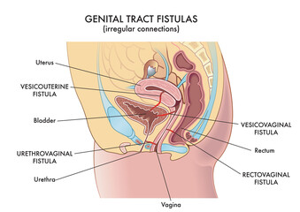 Medical illustration of the irregular connections called fistulas that can be found in the woman's genital tract. - obrazy, fototapety, plakaty