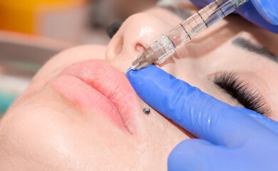 Lip augmentation. Beautician injects hyaluronic acid into the lips of a girl with a syringe. The...