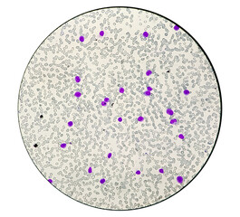Leuco-erythroblastic anaemia and Chronic myelomonocytic leukemia (CMML), MPD, Blood smear under...