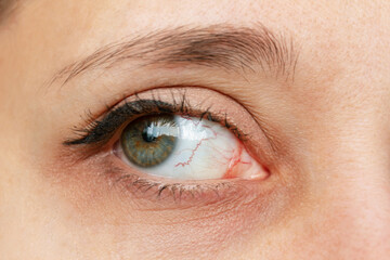 Close-up of female eye with red inflamed and dilated capillaries. Hemorrhage under the conjunctiva....