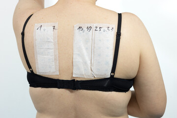 Patch tests stuck on the back of a woman, Tests for skin allergens, metals, preservatives,...