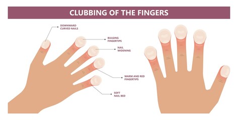 Nail clubbing. Symptoms tetralogy of Fallot bone swelling warning sign toenails coughing enlarged cyanosis late fingertips problem liver toe skin watch glass ild ipf pain copd - obrazy, fototapety, plakaty