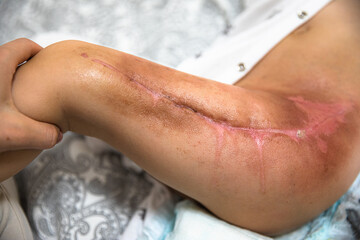 Burned area on the leg following radiotherapy, surgery to remove the cancerous tumor