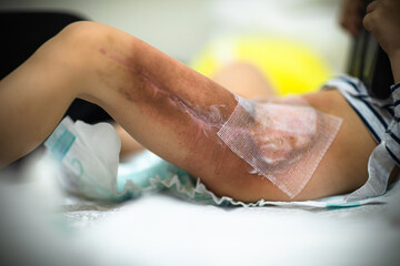Burned area on the leg following radiotherapy, surgery to remove the cancerous tumor