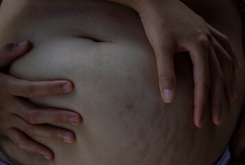 fat stretch marks and overweight problems