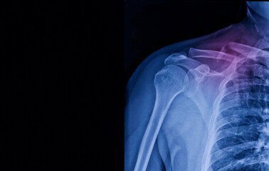 A photo of plain radiograph on dark background in hospital. The film use for diagnosis the illness of patient.Medical concept. A children with fracture clavicle.