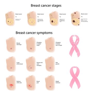 Female breast cancer symptoms and stages, illustration