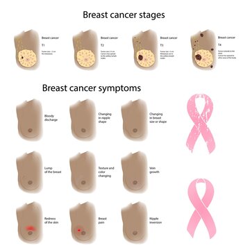 Female breast cancer symptoms and stages, illustration