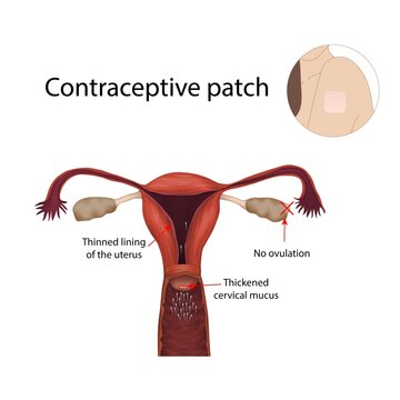 Contraceptive patch, illustration