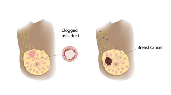 Clogged milk duct and breast cancer comparison, illustration