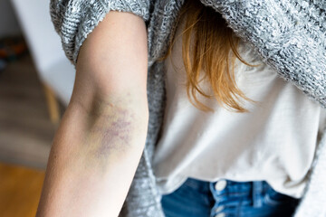 discolored area on the arm after infusion