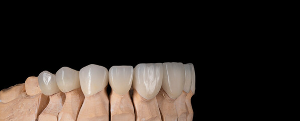 natural look press ceramic crowns