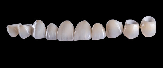 natural look press ceramic crowns