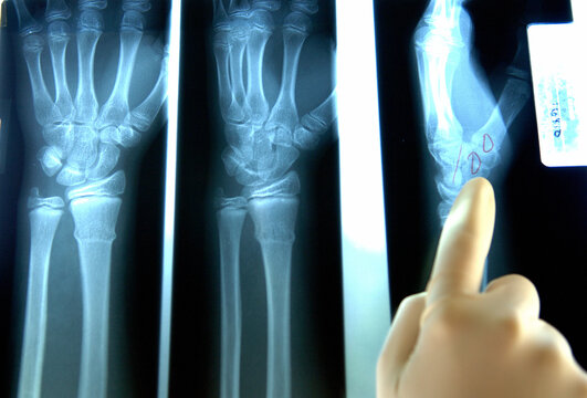 Human hand and wrist x-rays.