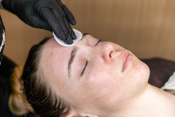 Fototapeta na wymiar Cleansing the face with a cotton sponge after a cosmetic procedure.