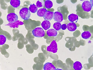 Chronic myeloid leukemia cells or CML, analyze by microscope, original magnification 400x