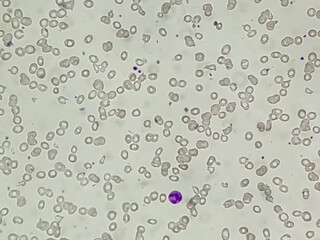 Dimorphic anemia analyzed by microscope. It is also called  iron- deficiency and macrocytic anemia.