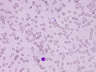Macrocytic anemia with features of hemolysis and nucleated RBC analyzed by microscope. 