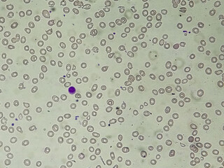 Macrocytic anemia with features of hemolysis and nucleated RBC analyzed by microscope. 